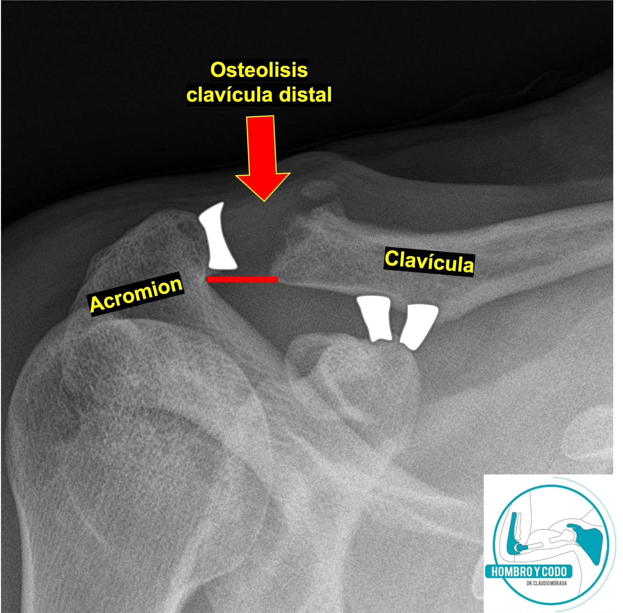 Osteólise Distal Da Clavícula SOLOLEARN