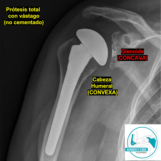 Artrosis De Hombro Pr Tesis Total Anat Mica Cirujano Hombro Codo