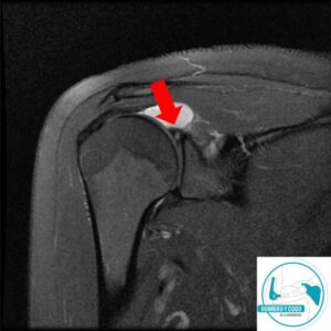 lesión slap mri