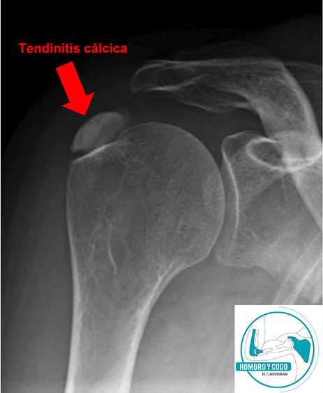 Tendinitis cálcica del hombro en radiografía