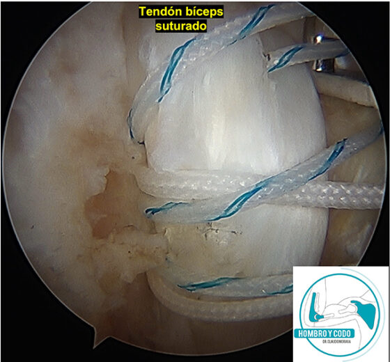 Tenodesis del bíceps proximal