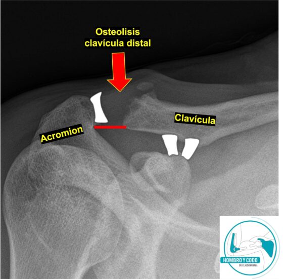 Osteólisis de la clavícula distal (hombro del pesista)