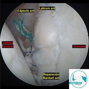 inestabilidad anterior de hombro tratamiento quirúrgico
