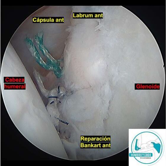 inestabilidad anterior de hombro tratamiento quirúrgico