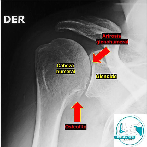 Artrosis de hombro (glenohumeral) en radiografía