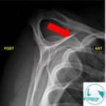 Inestabilidad anterior de hombro: inestabilidad glenohumeral