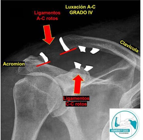Luxación acromioclavicular grado 4