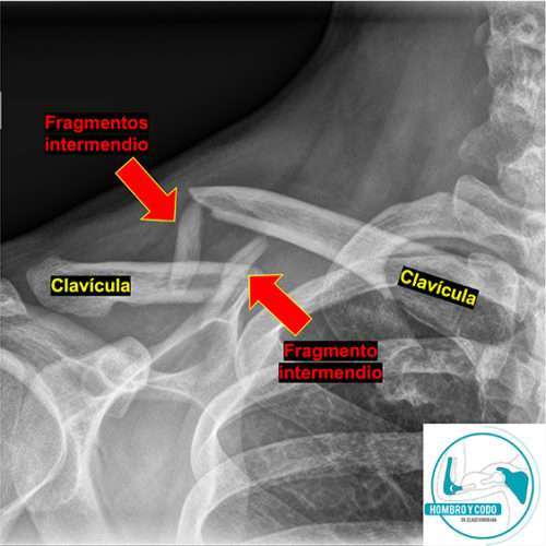 Fractura Clavícula – Cirujano Hombro & Codo