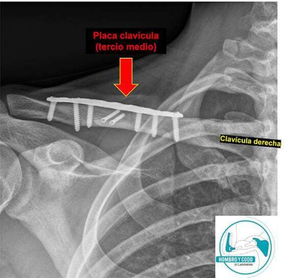 Cirugía de fractura de clavícula: fijación con placa y tornillos