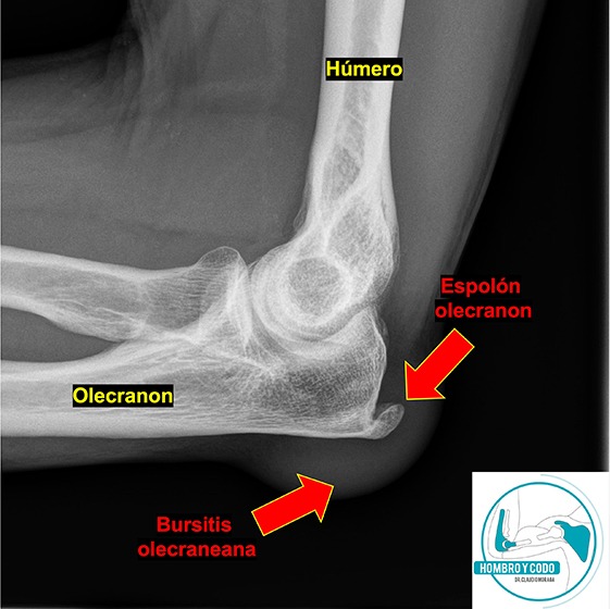 Radiograf a De Bursitis Del Ol cranon