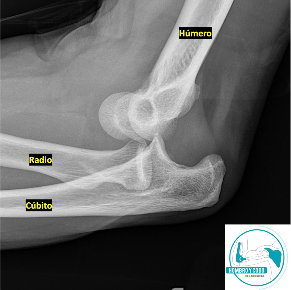 Luxación Y Luxofractura Del Codo – Cirujano Hombro & Codo