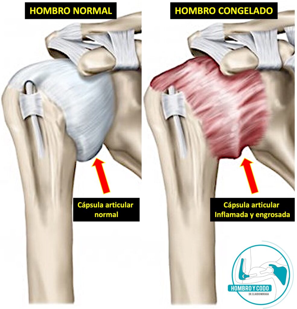 Hombro Congelado Traumatologo Hombro Congelado Causas Hombro Congelado Traumatologo Hombro Congelado Causas