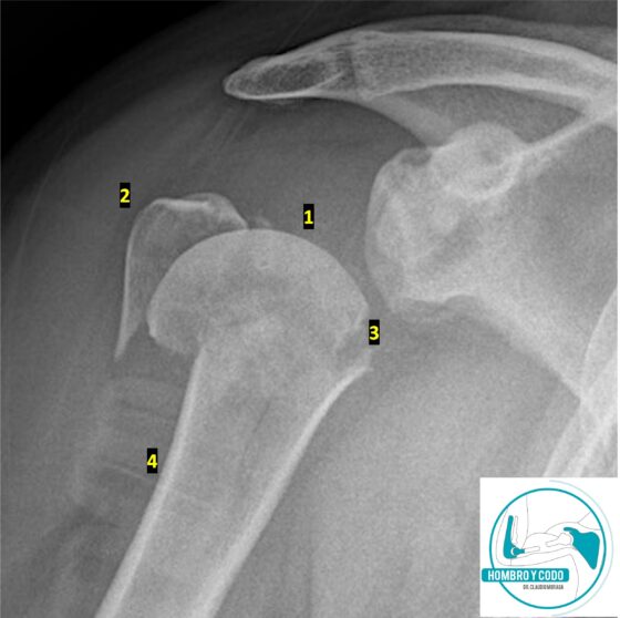 Fractura del húmero proximal