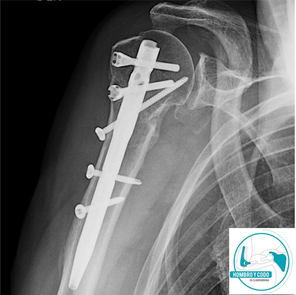 Fractura húmero proximal clavo endomedular