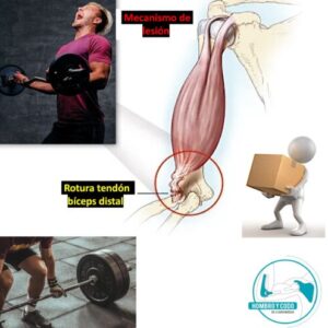 rotura bíceps distal