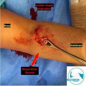 Rotura bíceps distal tratamiento quirúrgico