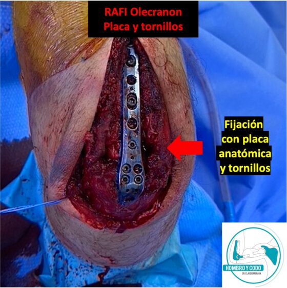 Cirugía de fractura de olécranon: placa y tornillos