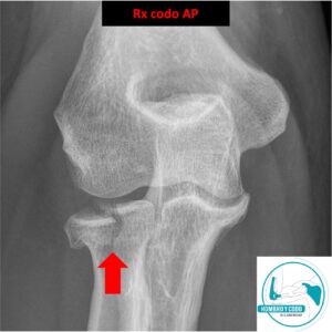 Fractura cúpula radial