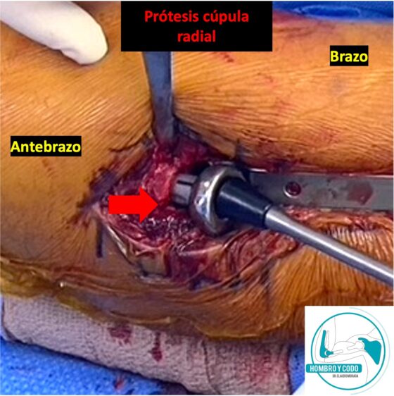 Cirugía de fractura de cúpula radial: prótesis de cúpula