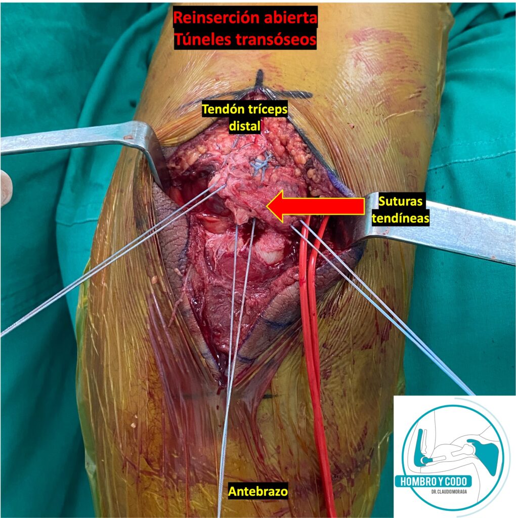 cirugía de reparación abierta en rotura tendón tríceps distal de codo