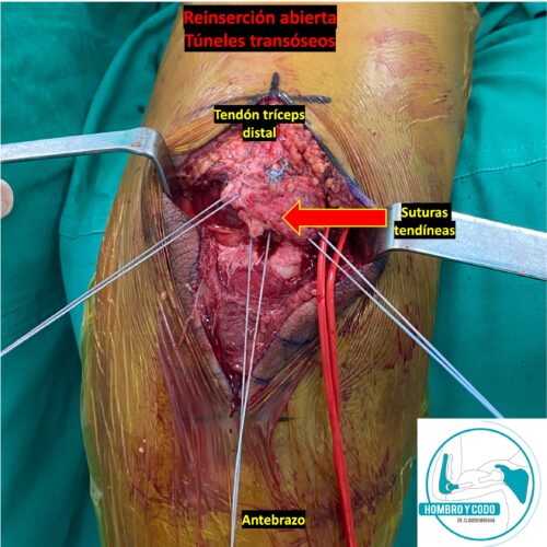 Rotura tendón tríceps distal - Tratamiento quirúrgico