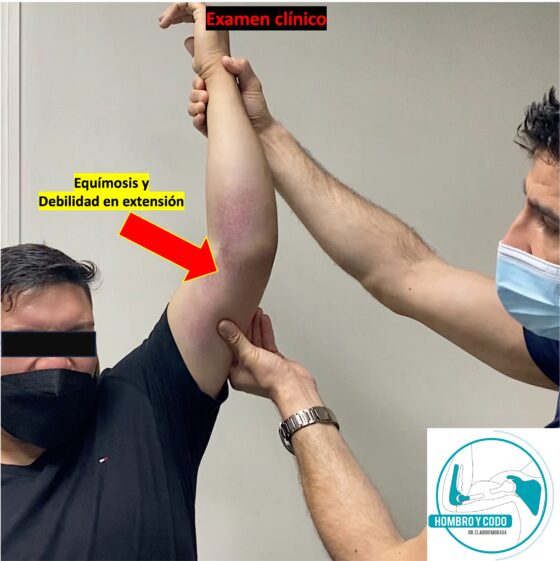 Rotura del tríceps distal: examen clínico