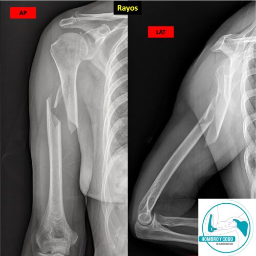 Fractura húmero diafisiario