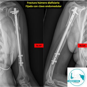 Fractura húmero diafisiario  - Tratamiento quirúrgico