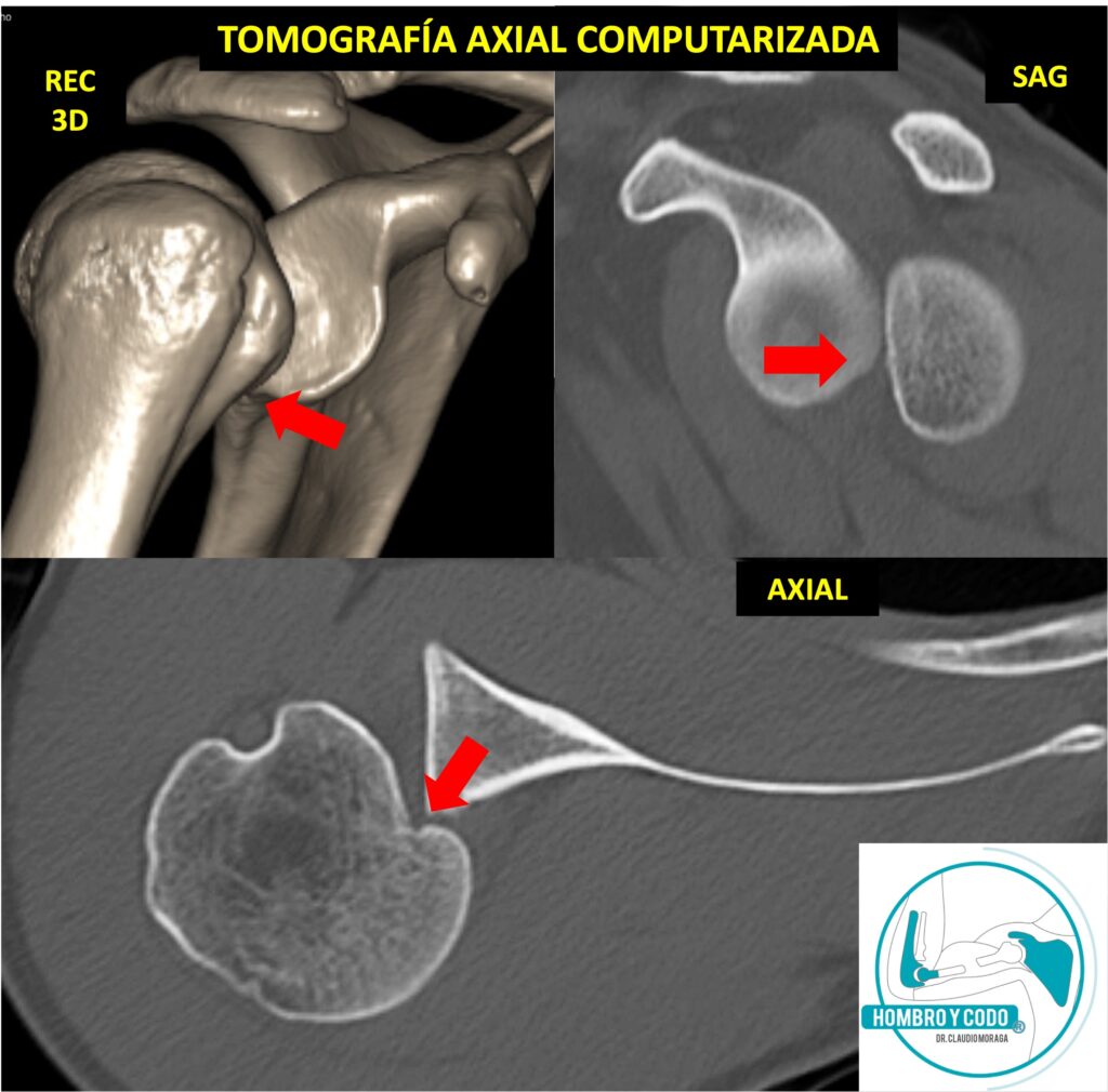 Inestabilidad posterior de hombro