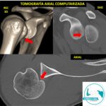 Inestabilidad posterior de hombro