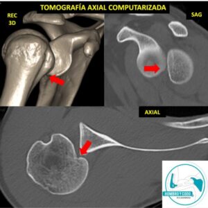 Inestabilidad posterior de hombro