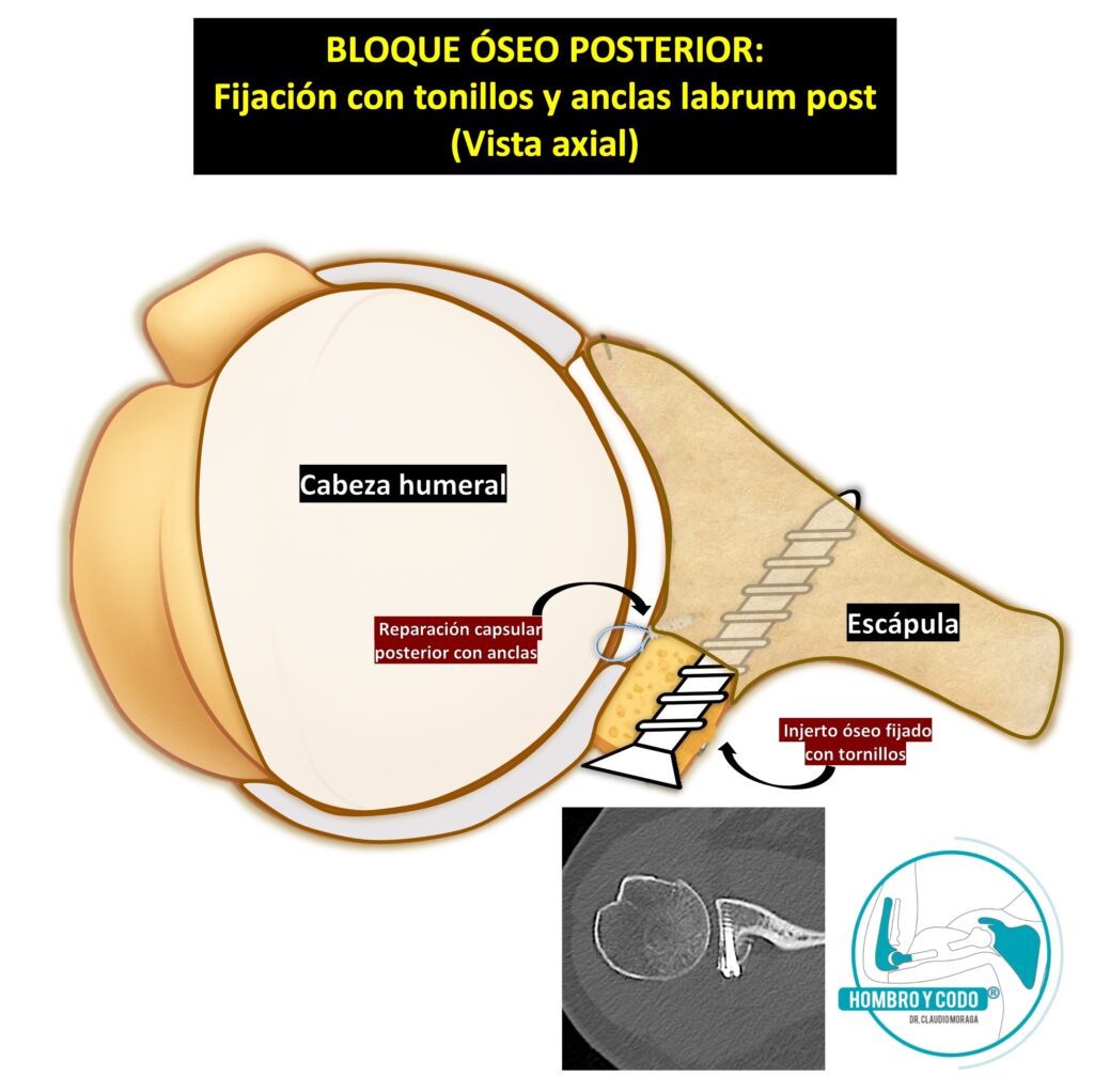Inestabilidad Posterior de Hombro Tratamiento Quirúrgico