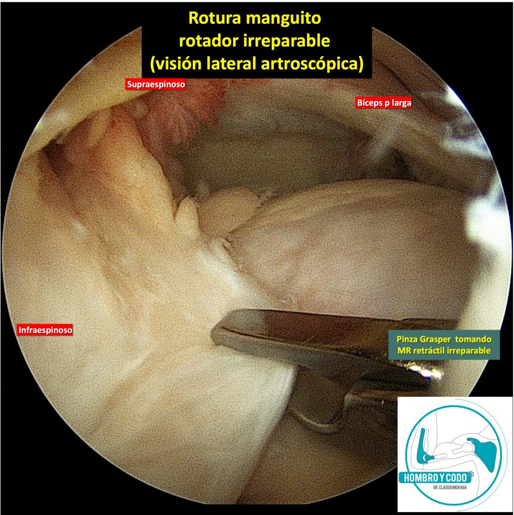 rotura manguito rotador irreparable vision artroscopica lateral tendón supraespinoso retráctil