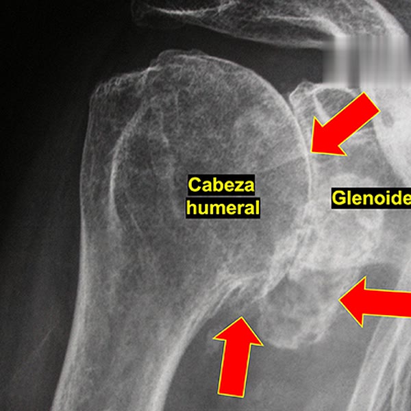 Artrosis glenohumeral