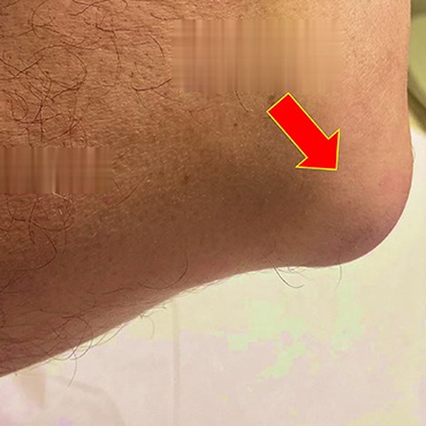 Bursitis olecraneana