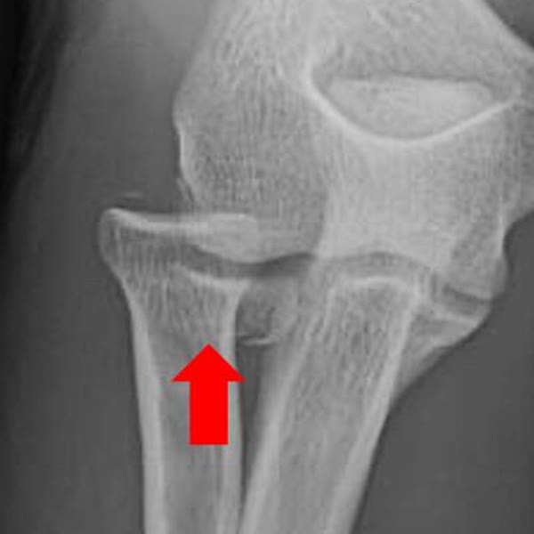 Fractura de cúpula radial