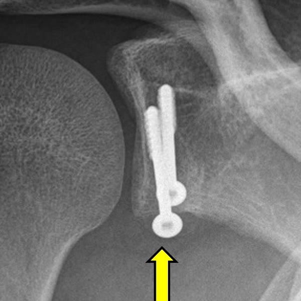 Latarjet: inestabilidad anterior