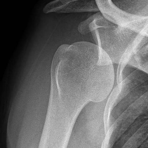Luxación glenohumeral