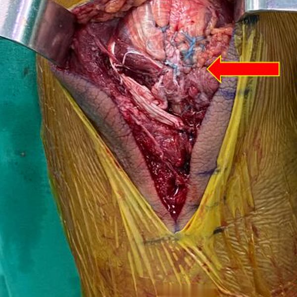 Reparación del tríceps distal