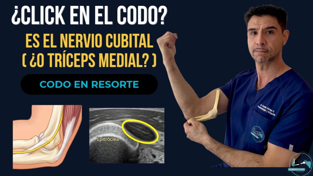 Codo en resorte: luxación del nervio cubital y tríceps medial