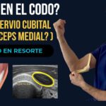 Codo en resorte: luxación del nervio cubital y tríceps medial